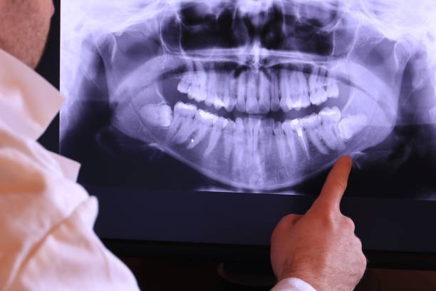 Best Emergency Wisdom Teeth Removal in Dove Valley, CO