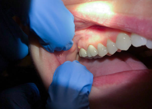 Best Emergency Root Canal Treatment in Dove Valley, CO